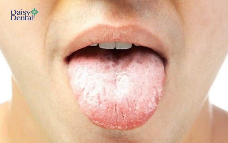 Khi lưỡi xuất hiện nhiều đốm trắng là dấu hiệu của bệnh nhiễm nấm Candida hay tưa miệng