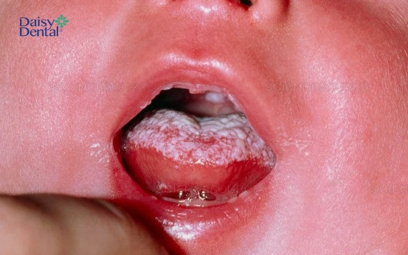 Hình ảnh mặt trên và mặt dưới lưỡi xuất hiện nhiều đốm trắng do nấm Candida gây ra