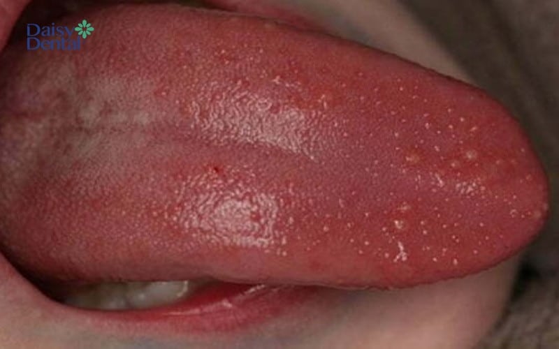 Hình ảnh nấm miệng ở trẻ em xuất hiện khiến lưỡi sưng đỏ, đau