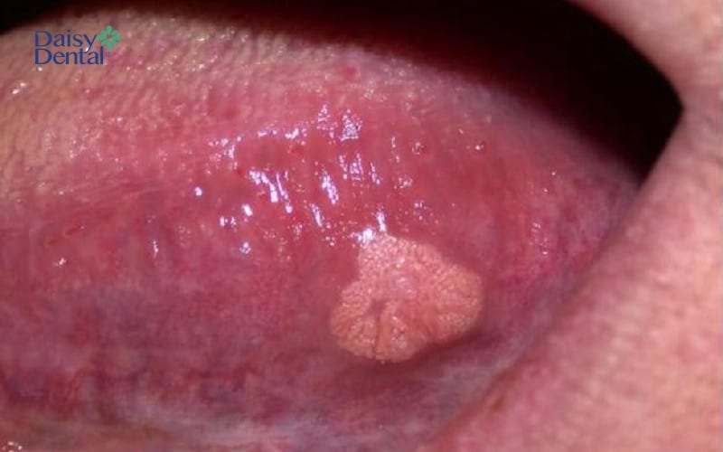 Hình ảnh u nhú ở lưỡi do virus HPV gây ra