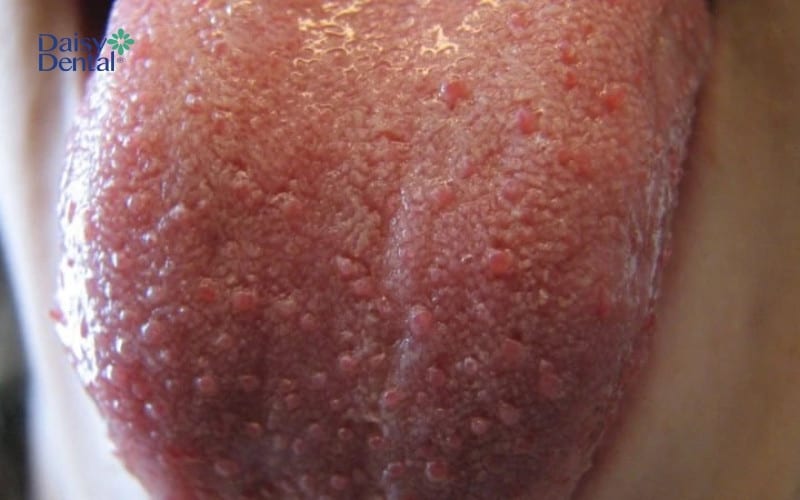 Hình ảnh u nhú ở lưỡi gây đau nhức cho người bệnh
