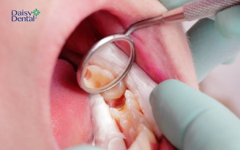 Hình ảnh cho thấy sâu răng phát triển khiến men răng và cấu trúc răng bị tổn thương