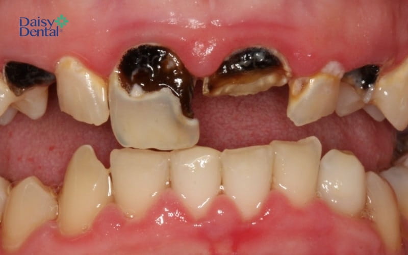 Cấu trúc răng bị phá hủy do mô sâu phát triển, lan rộng