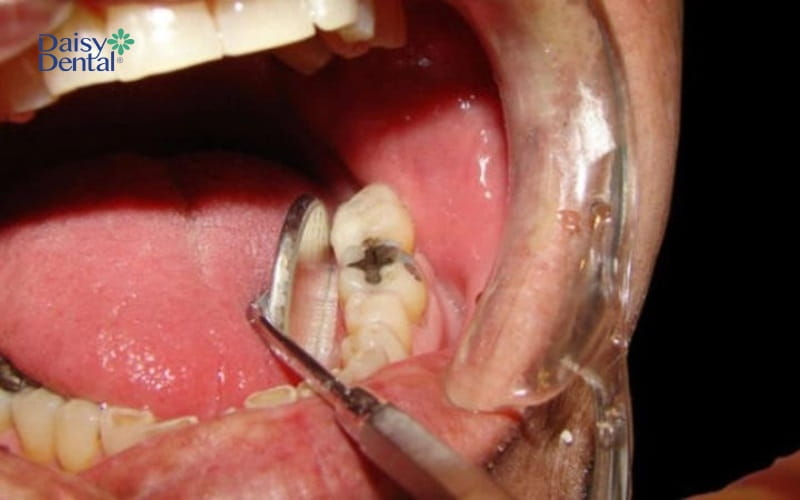 Hình ảnh răng bị sâu khiến tủy răng cũng dần bị ảnh hưởng