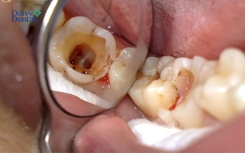 Tủy răng bị viêm nhiễm, hoại tử do sâu răng phát triển