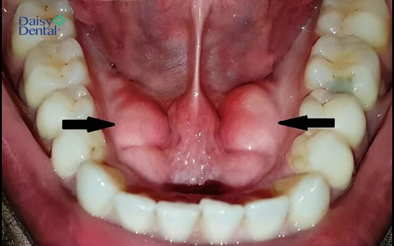 Hình dạng phổ biến khi xương chân răng bị nhô ra ở hai bên