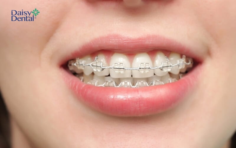 Khuôn mặt bị lệch do răng thì bạn có thể niềng răng để điều chỉnh