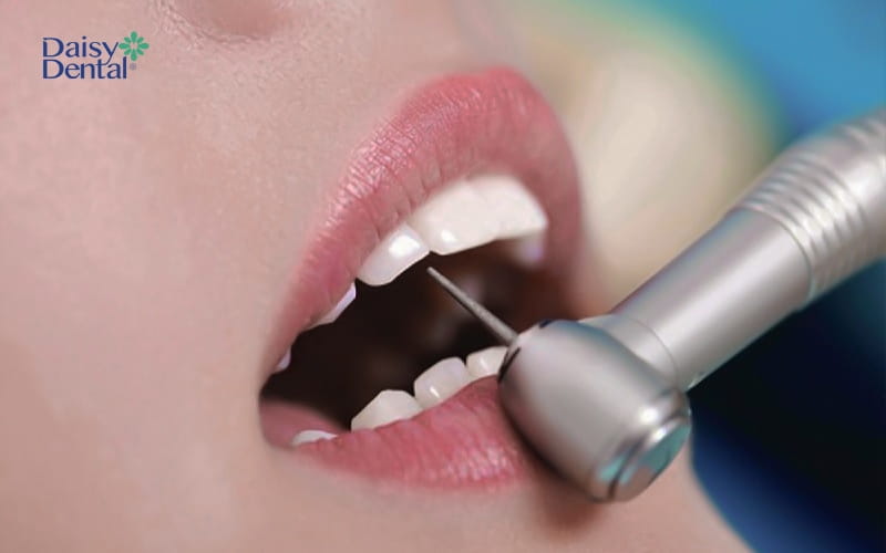 Mài răng là một trong những phương pháp trong nha khoa để xử lý răng hô