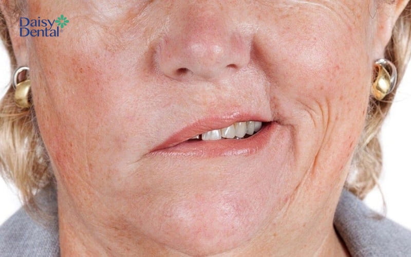 Mặt lệch khiến khuôn miệng không cười đẹp có thể là do di chứng của các bệnh lý