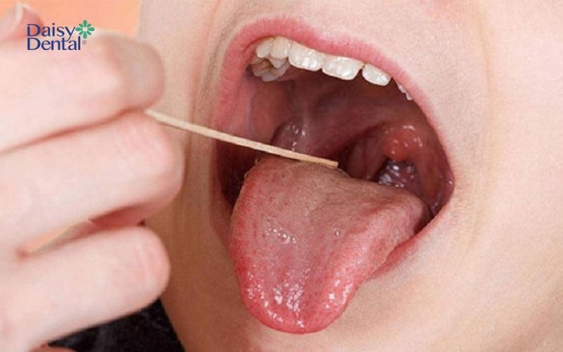 Nếu sau một thời gian, u nhú ở lưỡi vẫn không thuyên giảm thì bạn nên đến bệnh viện