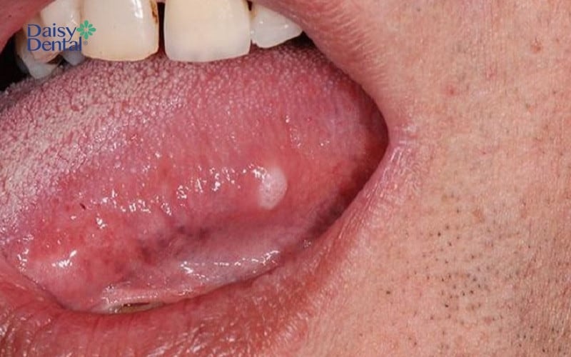 Nếu tình trạng kéo dài như hình ảnh u nhú ở lưỡi trên thì rất có thể do ung thư