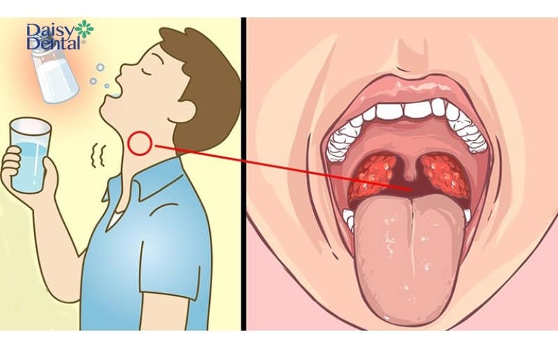 Ngậm nước muối giúp giảm đau họng