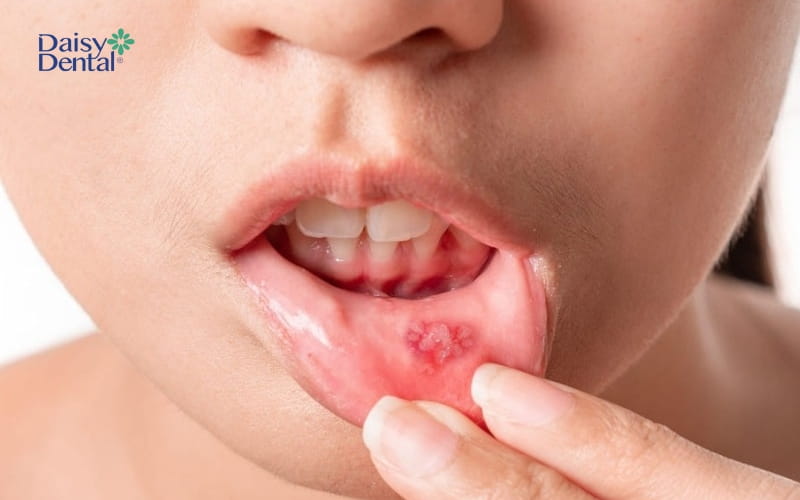 Nhiệt miệng là tình trạng xuất hiện nhiều vết lở loét viền đỏ, hình tròn hoặc hình oval
