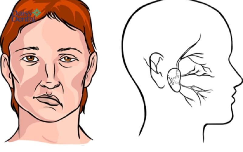 Nhiều người bị lệch mặt do ảnh hưởng từ dây thần kinh
