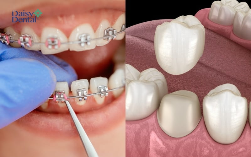 Niềng răng và bọc răng sứ là kỹ thuật khắc phục tình trạng răng móm rất hiệu quả