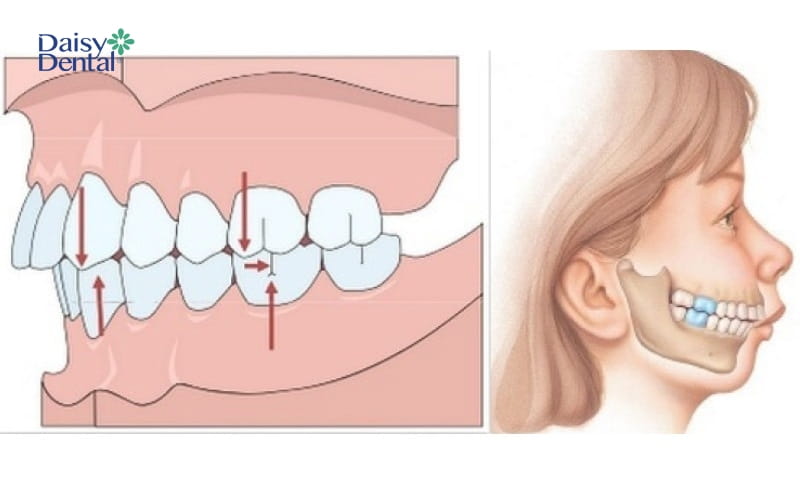 Phẫu thuật chỉnh hàm là kỹ thuật khắc phục hiệu quả tình trạng răng bị lệch do xương hàm