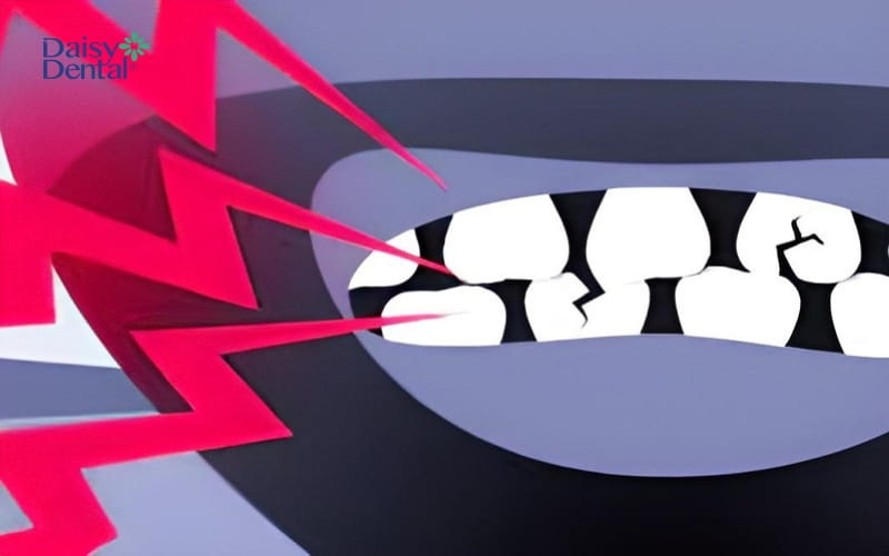 Thói quen nghiến răng sẽ làm nguy cơ lồi xương chân răng tăng cao