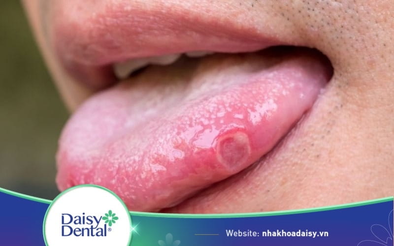 Hình ảnh đẹn miệng và triệu chứng nhận biết sớm bệnh lý