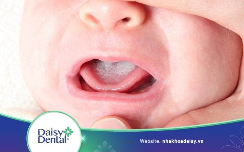 hình ảnh trẻ bị tưa lưỡi
