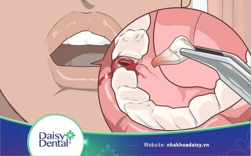 mẹo cầm máu sau khi nhổ răng