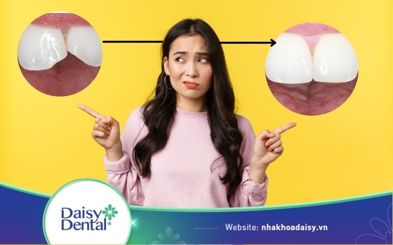 Răng bị mẻ có tự lành được không? Cách phục hình răng mẻ