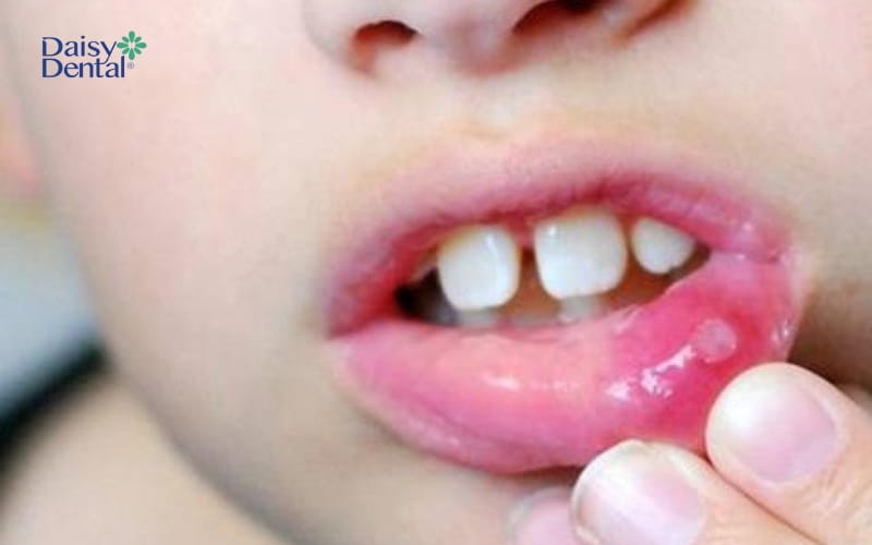 Trẻ bị đau, rát khi vết loét xuất hiện trên môi