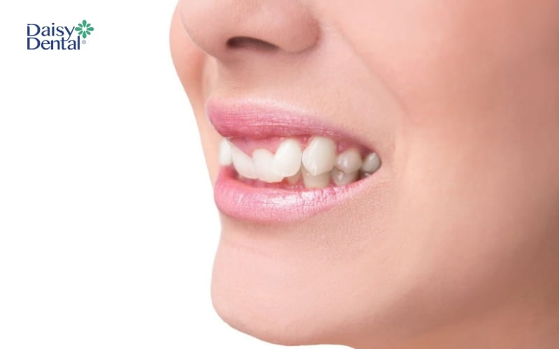 Tuổi thọ của răng khểnh phụ thuộc vào vật liệu Composite