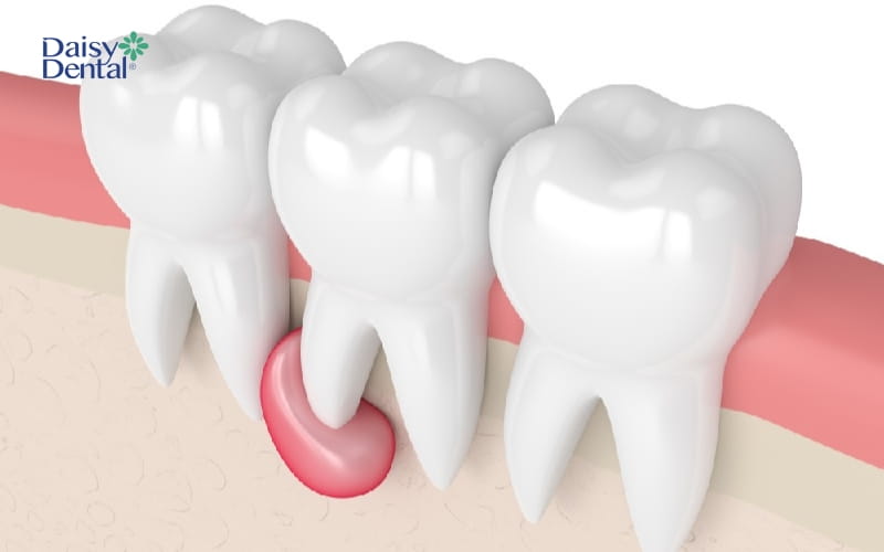 U nang dưới răng có khả năng dẫn đến tình trạng nổi cục ở lợi