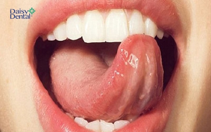 U nhú lưỡi là tình trạng thường thấy và không quá nghiêm trọng