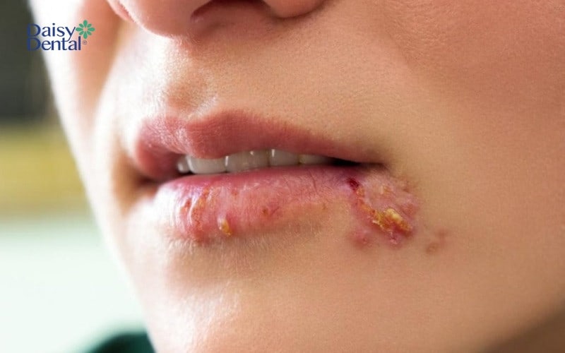 Vi khuẩn Herpes gây ra nhiều vết loét ở khóe môi và có thể ở mặt dưới của lưỡi