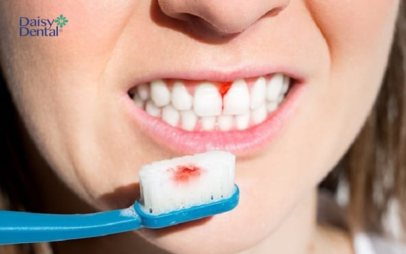 Bàn chải đánh răng có lông cứng cũng là lý do khiến chân răng bị chảy máu