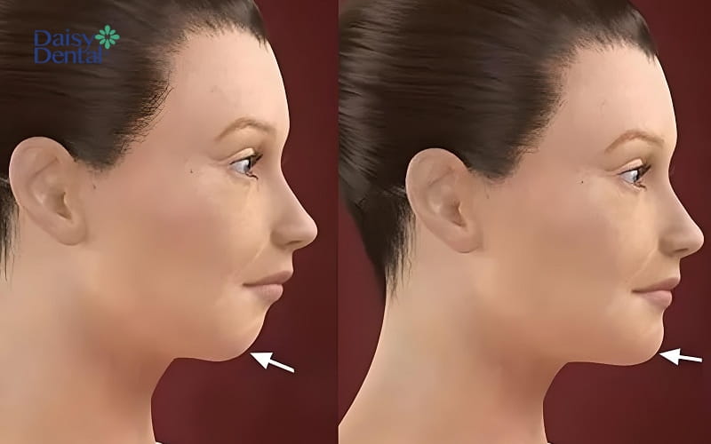 Bạn có thể tập Mewing cằm lẹm để cải thiện hình dáng của gương mặt