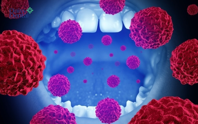 Chân răng có thể bị chảy máu nếu có tế bào ung thư phát triển trong khoang miệng