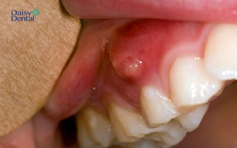 Chân răng sưng đỏ, dịch mủ xuất hiện gây ra cảm giác đau nhức khó chịu ở người bệnh
