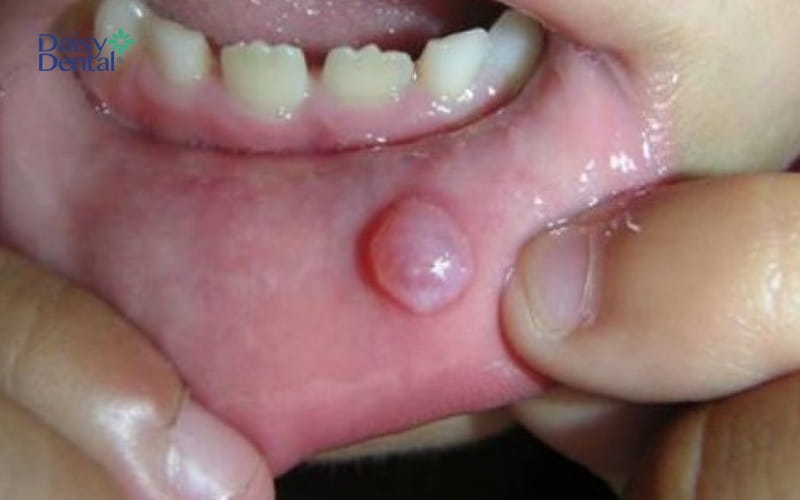 Cục u trong khoang miệng có thể ảnh hưởng đến tính mạng nếu nguyên nhân là từ các bệnh lý
