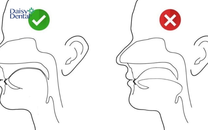 Đặt toàn bộ lưỡi lên vòm miệng là cách Mewing cằm lẹm đúng cách