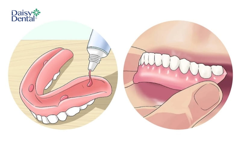 Dùng keo là cách dán răng giả bị rớt đơn giản và hiệu quả nhất