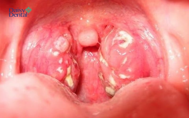 Hình ảnh amidan, vòm họng bị sưng to, có hốc mủ khi bệnh ở giai đoạn mãn tính