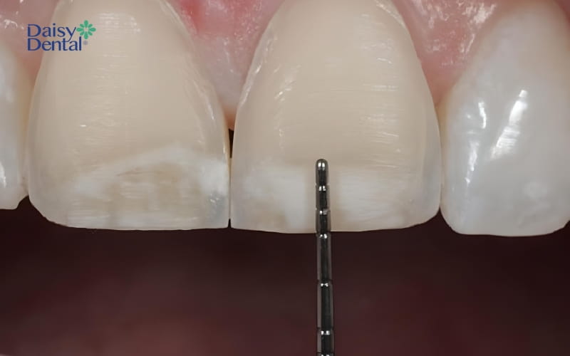 Hình ảnh bề mặt răng được mài một lớp cực mỏng
