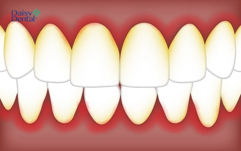 Không làm sạch răng thường xuyên có thể gây bệnh nha chu