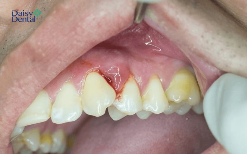 Lợi bị sưng viêm, nhiễm trùng sẽ dẫn đến tình trạng áp xe chân răng