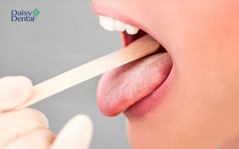 Lưỡi có màu bất thường cũng là một trong những triệu chứng ung thư lưỡi