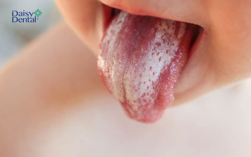 Lưỡi trắng là tình trạng phổ biến ở trẻ