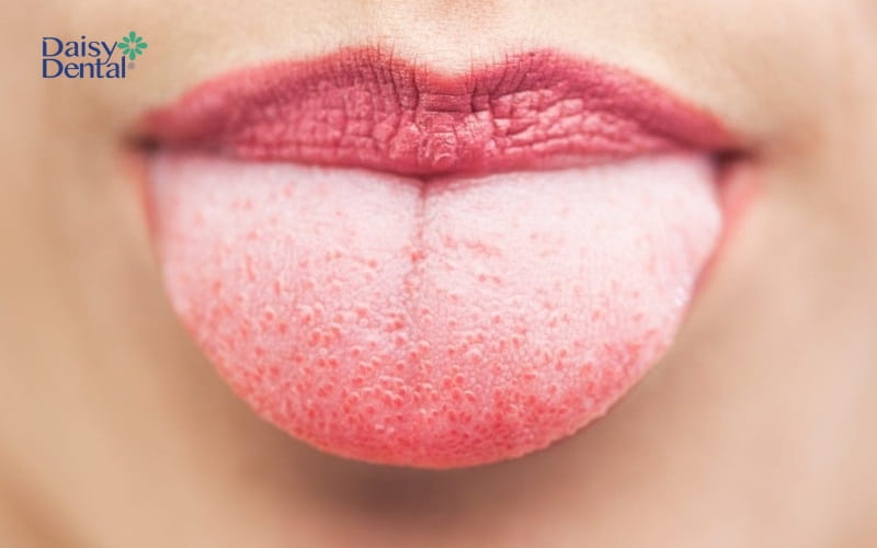 Một trong những biểu hiện của bệnh bạch sản niêm có thể khiến lưỡi nổi lấm tấm, sần sùi