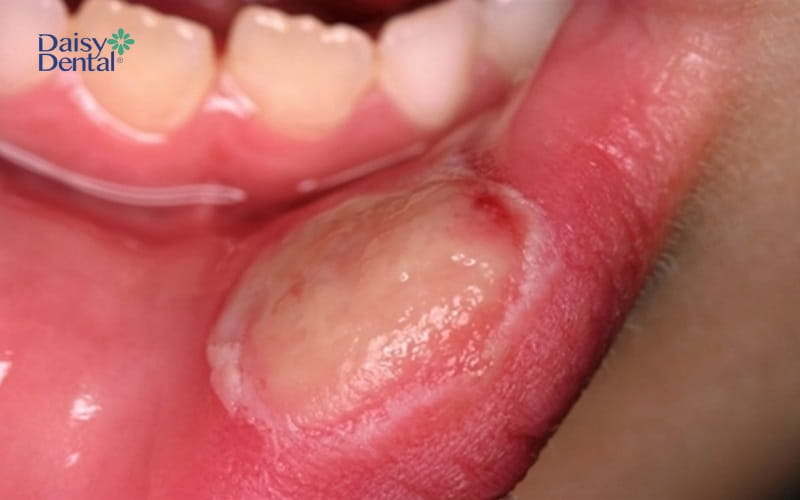 Niêm mạc miệng xuất hiện vết loét lớn, gây khó chịu ở người bệnh