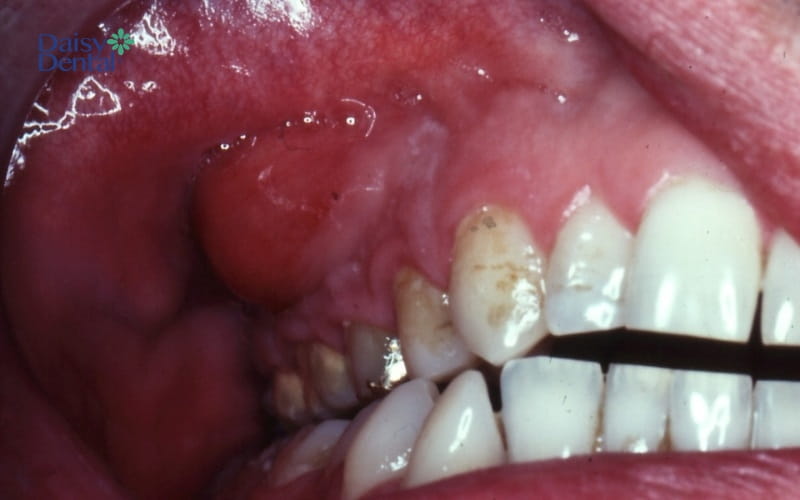 Nướu bị viêm nhiễm làm xuất hiện áp xe răng