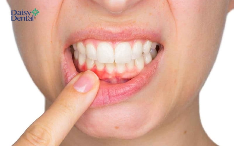 Nướu răng bị sưng đỏ nhẹ - viêm nha chu mức độ 1