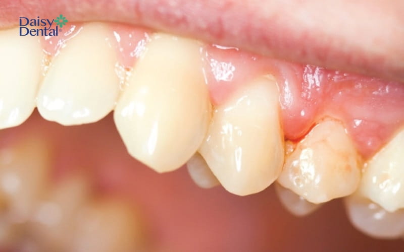 Nướu răng hơi sưng đỏ, thường bị chảy máu khi có áp lực