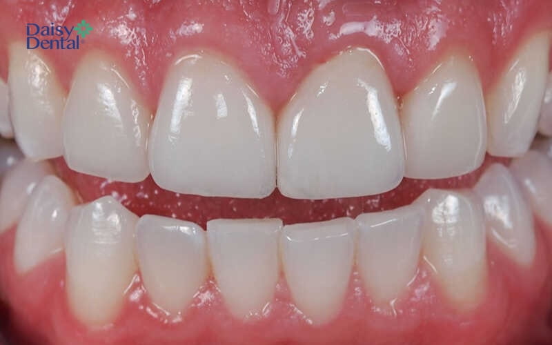 Nướu răng khỏe mạnh có màu hồng sẫm hoặc hồng nhạt