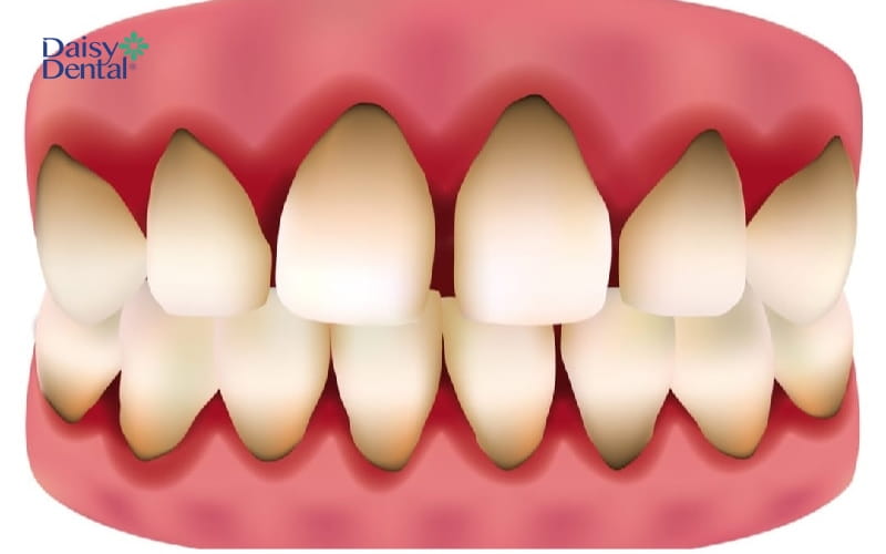 Phần nướu gần chân răng bị đen do bọc răng sứ kim loại
